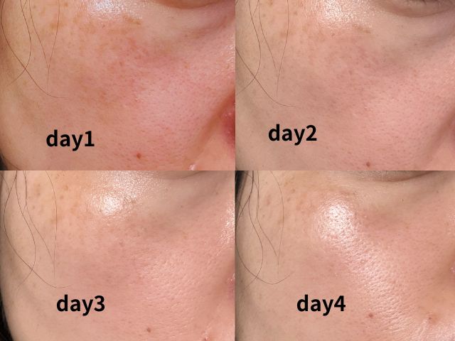 ポア ブライトニング シミケア セラム 効果はある？40代の頬で毎日使ってみた正直レビュー